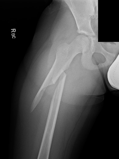 broken-femur